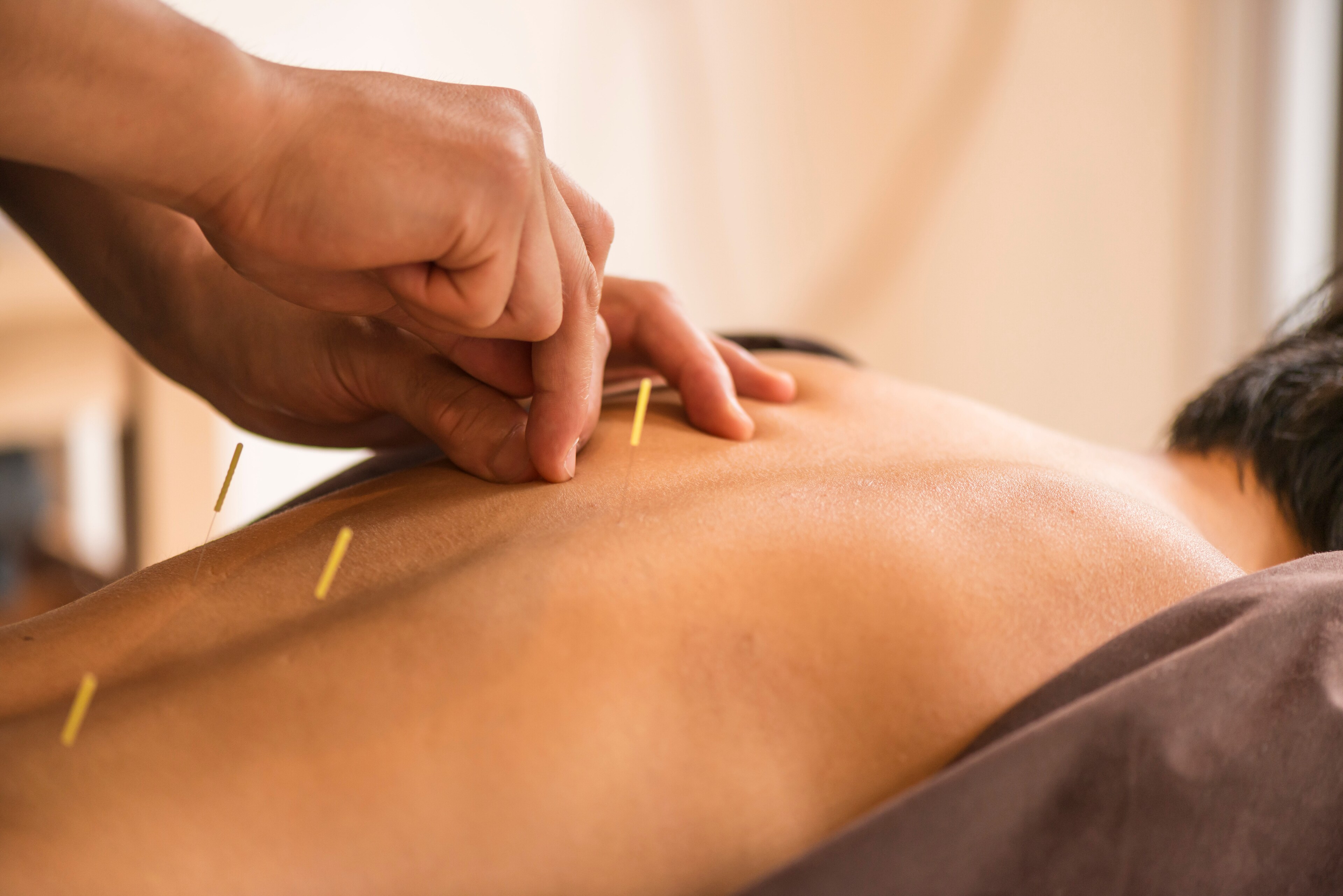 A therapist at Brij Medical Centre performs acupuncture on a patient.
