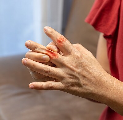 Senior Woman massage finger with painful swollen gout