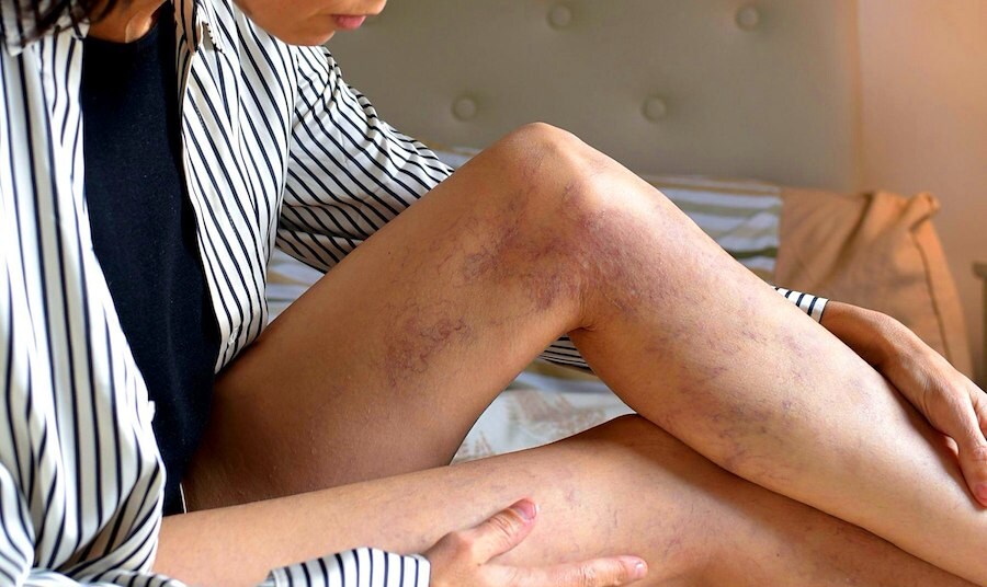 When Red Spots on Legs Signals Circulation Problems