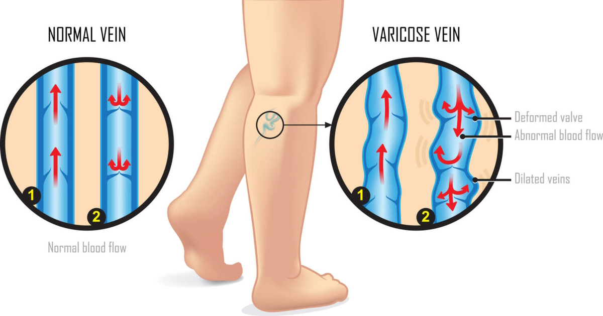 Can I Have Healthy Veins By Taking More Vitamin B12?