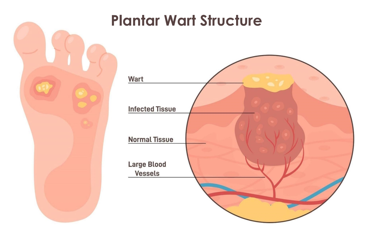Are Planters Warts Itchy? Causes, Symptoms & Relief Tips