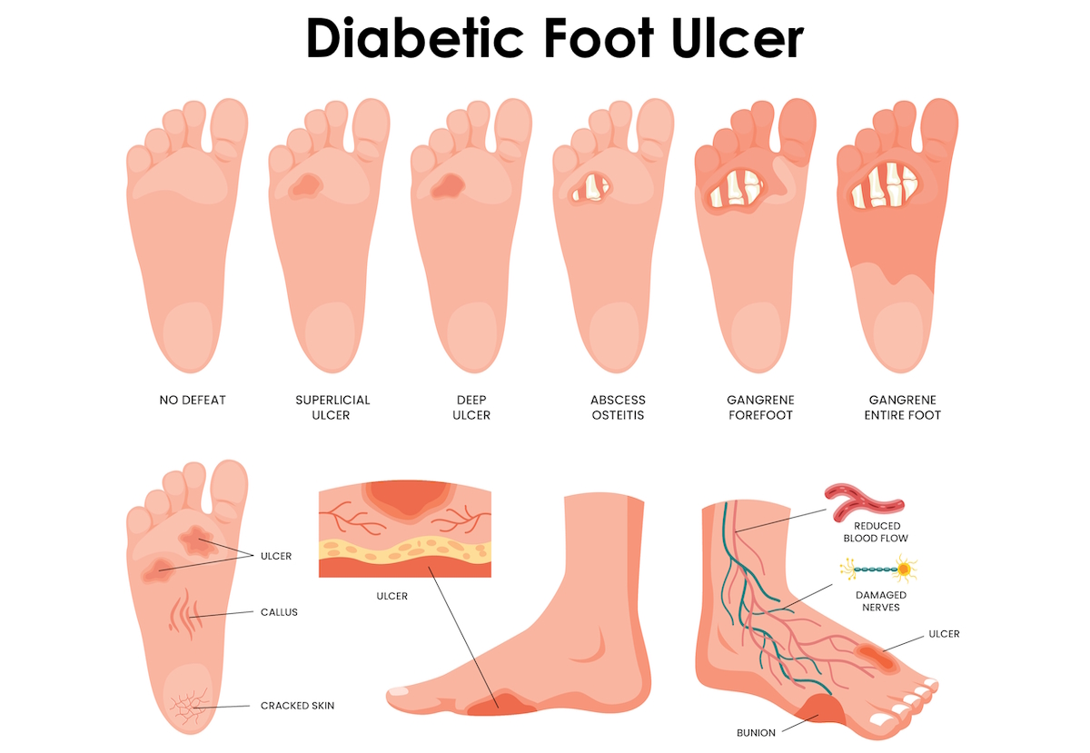 https://assets.milestoneinternet.com/stridecare/site-images/blog/wound-care-diabetic-foot-ulcer-adobe980348238.jpg